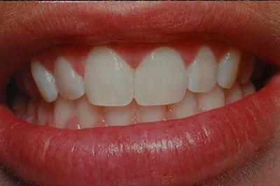 After treatment: composite veneers, case 2.