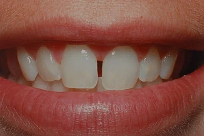 Before treatment: composite veneers, case 2.