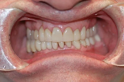 After treatment: full-mouth rehabilitation, case 5.