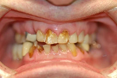 Before treatment: full-mouth rehabilitation, case 5.