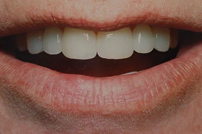 After treatment: porcelain veneers, case 1.