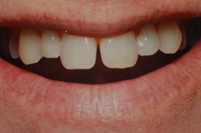 Before treatment: porcelain veneers, case 1.