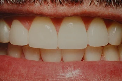 After treatment: porcelain crowns, case 4.