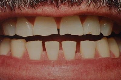 Before treatment: porcelain crowns, case 4.