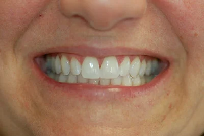 After treatment: teeth whitening, case 6.