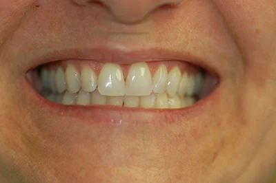 Before treatment: teeth whitening, case 6.