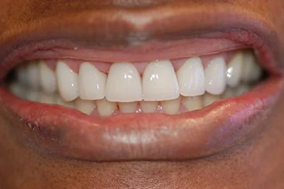 After treatment: porcelain veneers, case 3.