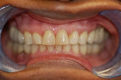 Before treatment: porcelain veneers, case 3.